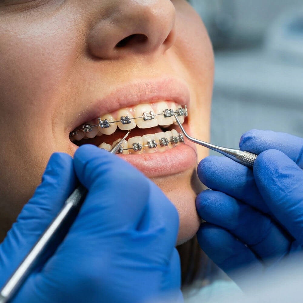 Braces